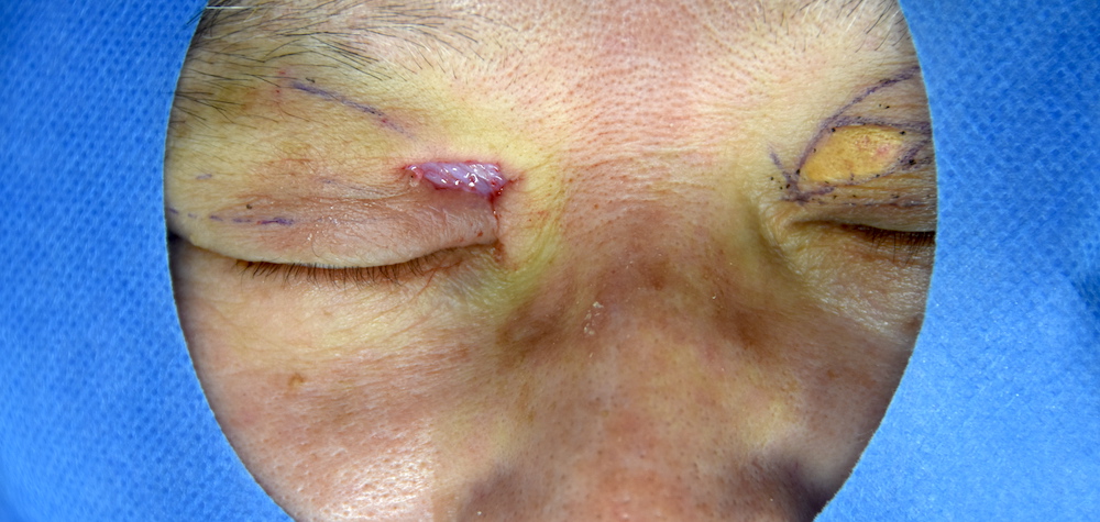 男性眼瞼黄色腫術中　大江橋クリニック