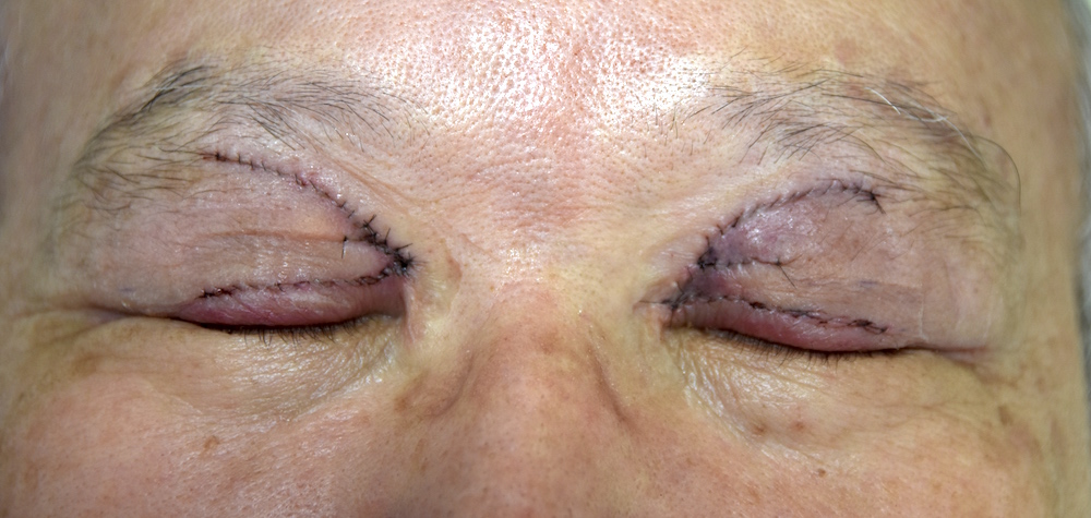 男性眼瞼黄色腫術直後　大江橋クリニック