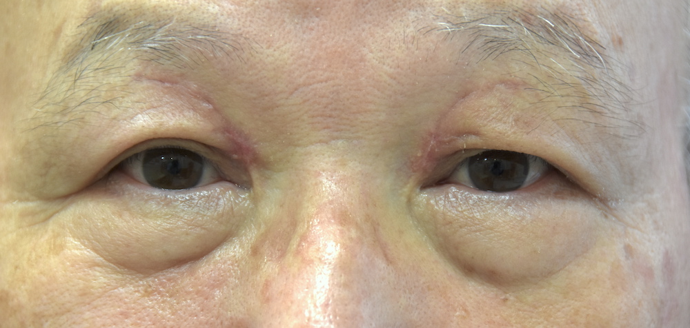 男性眼瞼黄色腫術後　大江橋クリニック