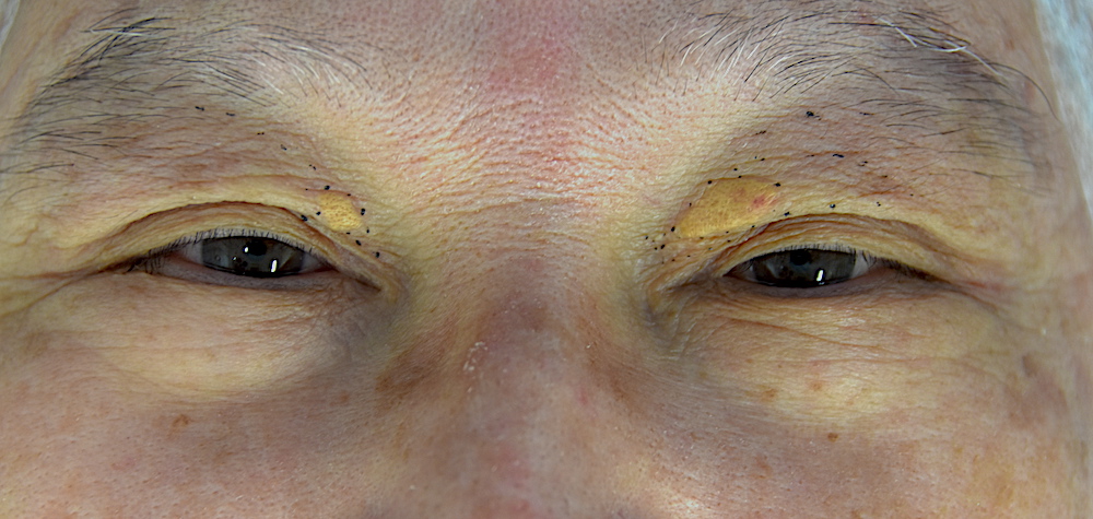 男性眼瞼黄色腫術前　大江橋クリニック