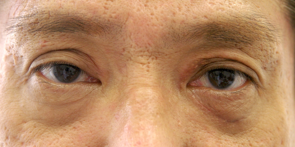 男性眼瞼黄色腫術後　大江橋クリニック