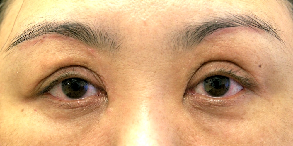 女性眼瞼黄色腫術後　大江橋クリニック