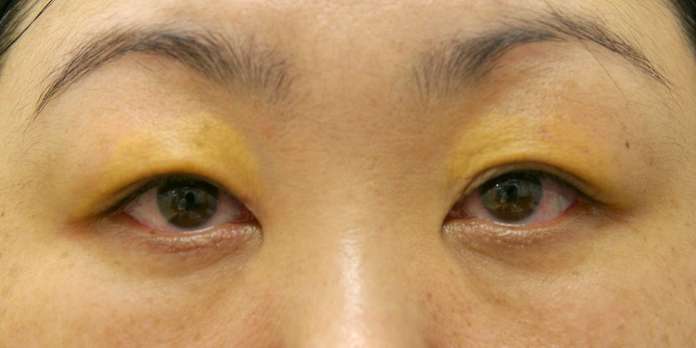 女性眼瞼黄色腫術前　大江橋クリニック