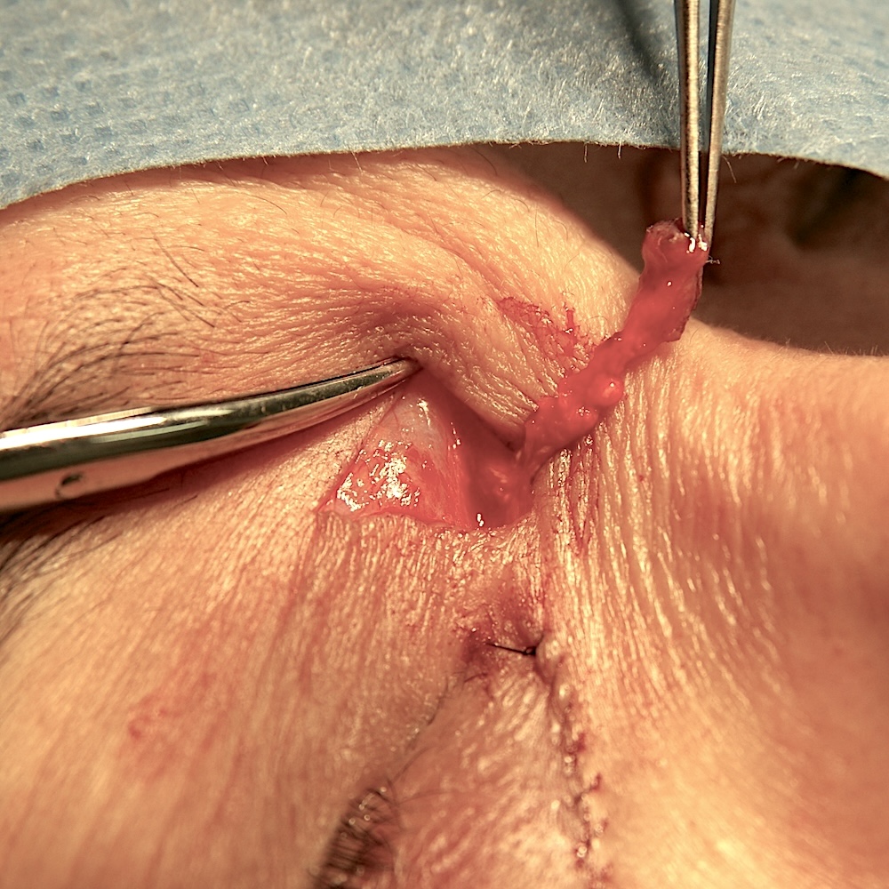 眼瞼黄色腫術中　大江橋クリニック