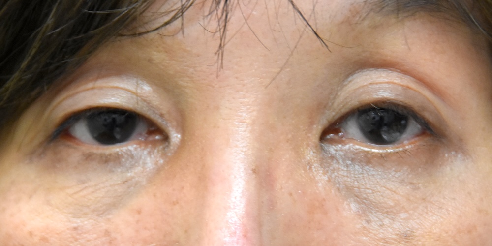 男性眼瞼黄色腫術前　大江橋クリニック