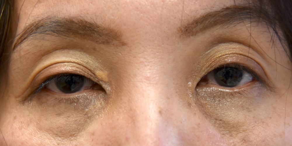 男性眼瞼黄色腫術前　大江橋クリニック