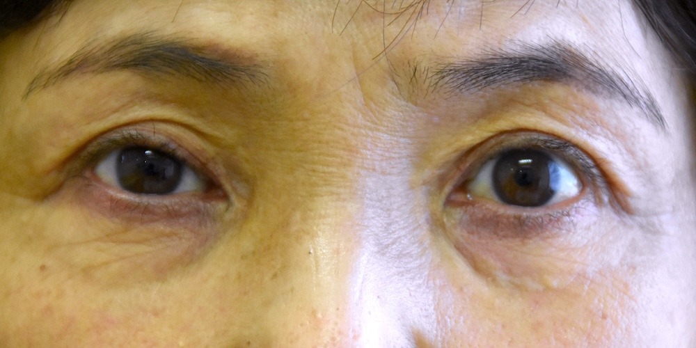 女性眼瞼黄色腫術前　大江橋クリニック