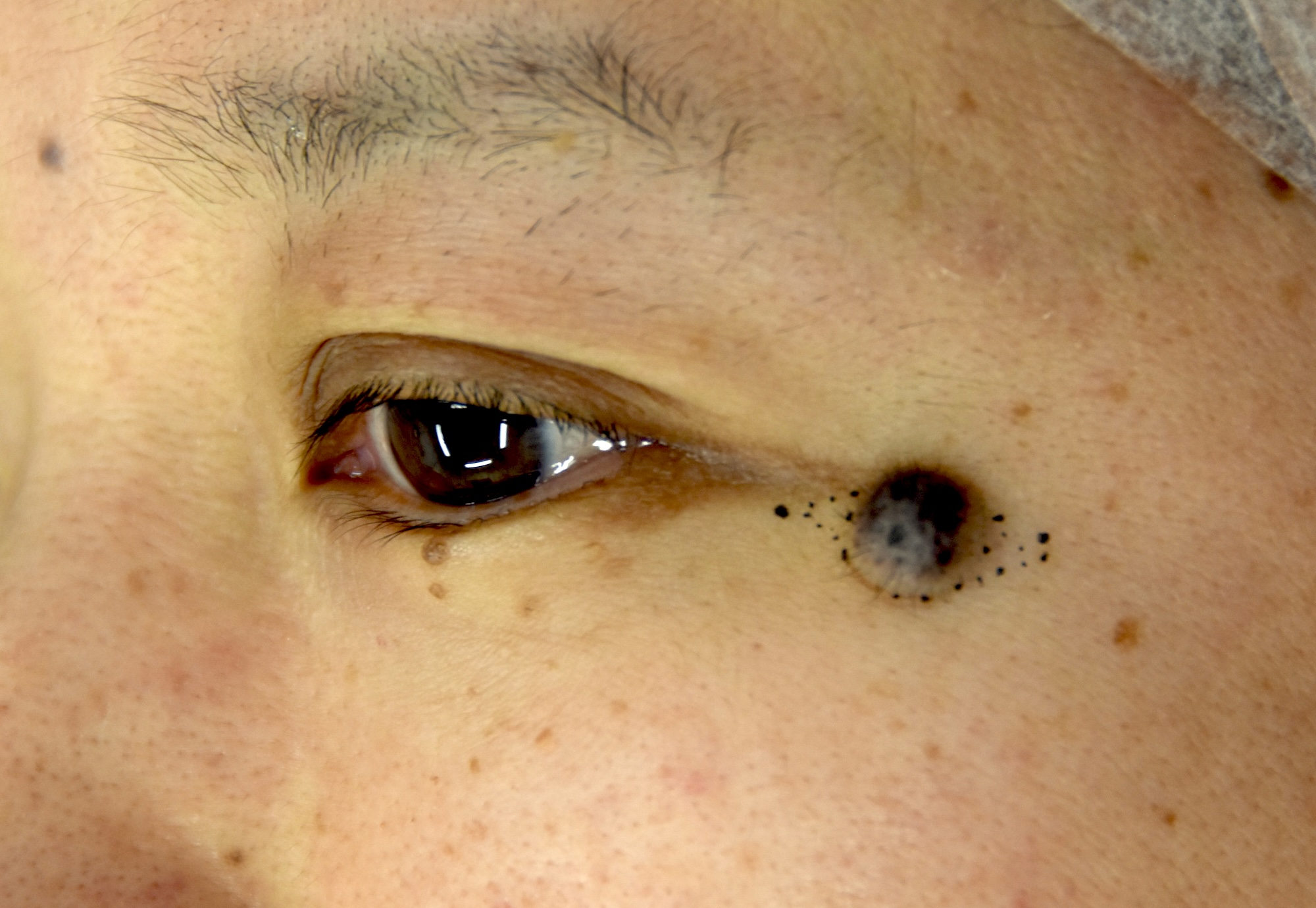 瞼ほくろ術前　大江橋クリニック