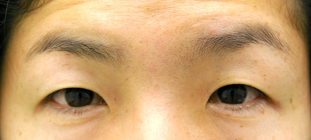 眼瞼下垂症術前　大江橋クリニック