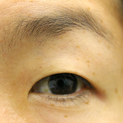 眼瞼下垂症術前左開瞼　大江橋クリニック