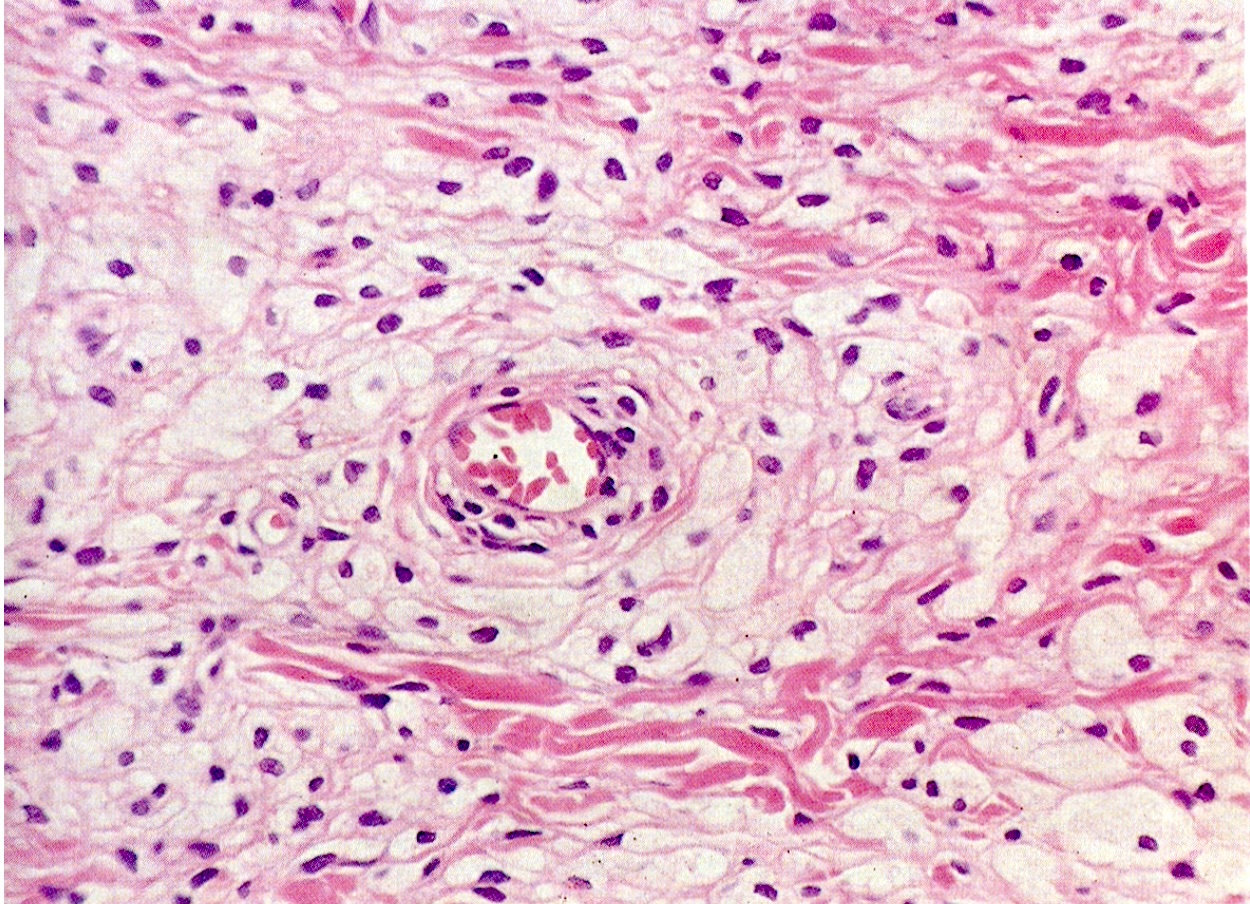 眼瞼黄色腫　大江橋クリニック